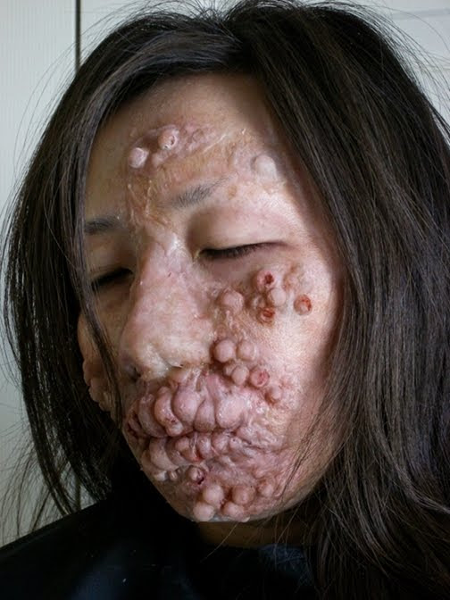 leprosy