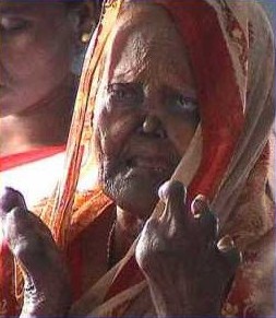 leprosy2